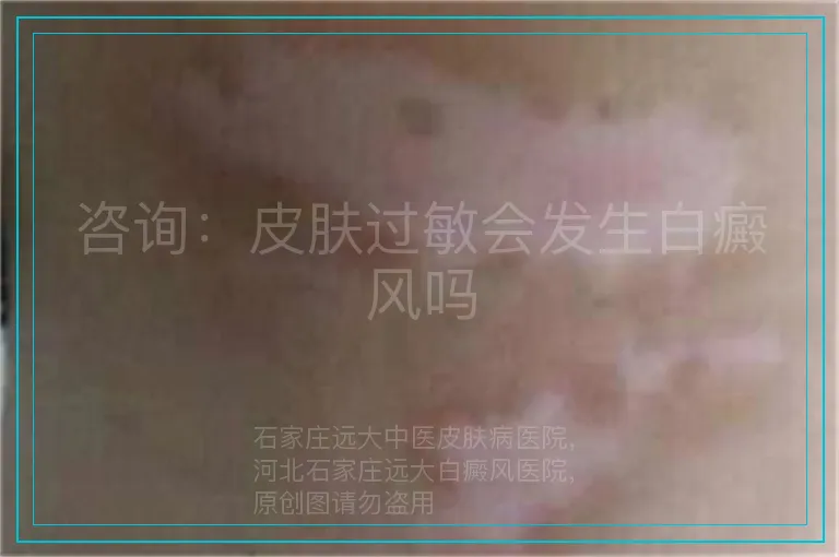 咨询：皮肤过敏会发生白癜风吗