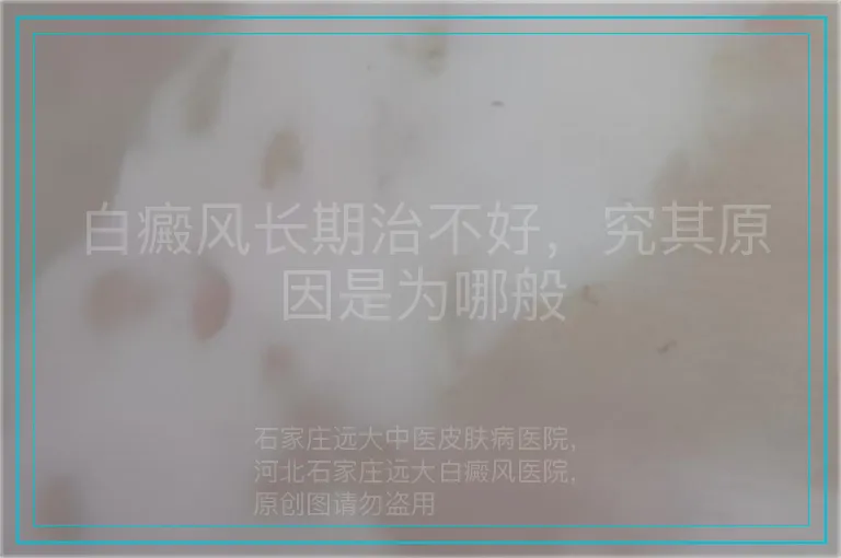 白癜风长期治不好，究其原因是为哪般