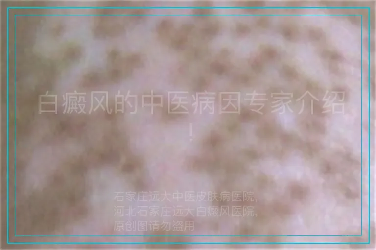 白癜风的中医病因专家介绍!