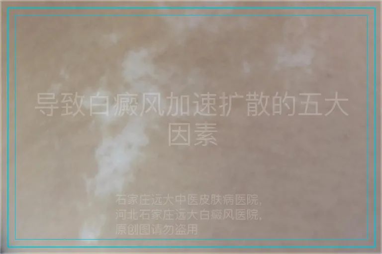 导致白癜风加速扩散的五大因素