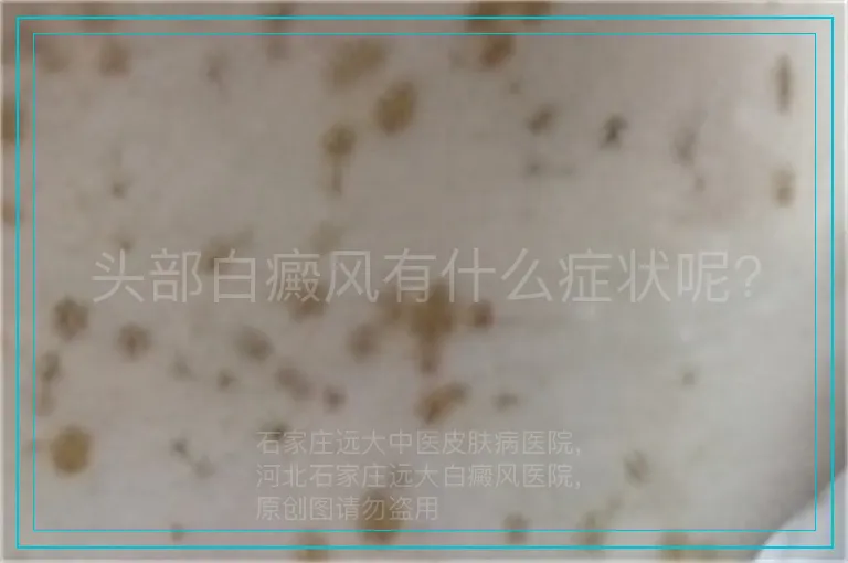 头部白癜风有什么症状呢?