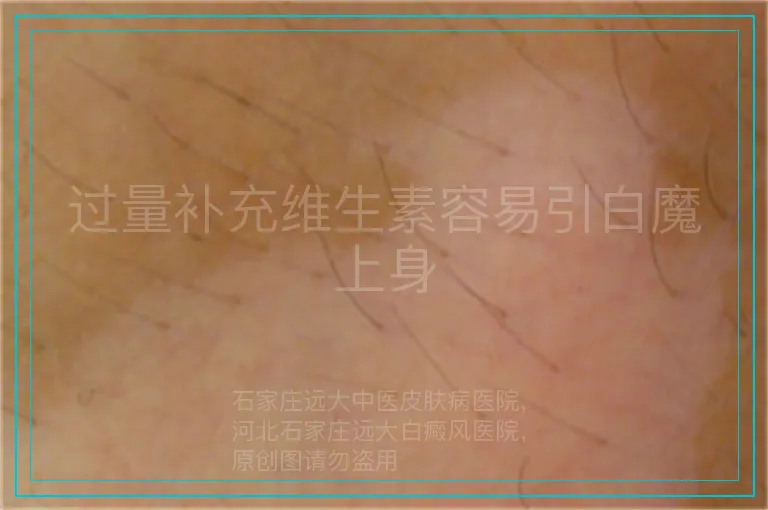 过量补充维生素容易引白魔上身