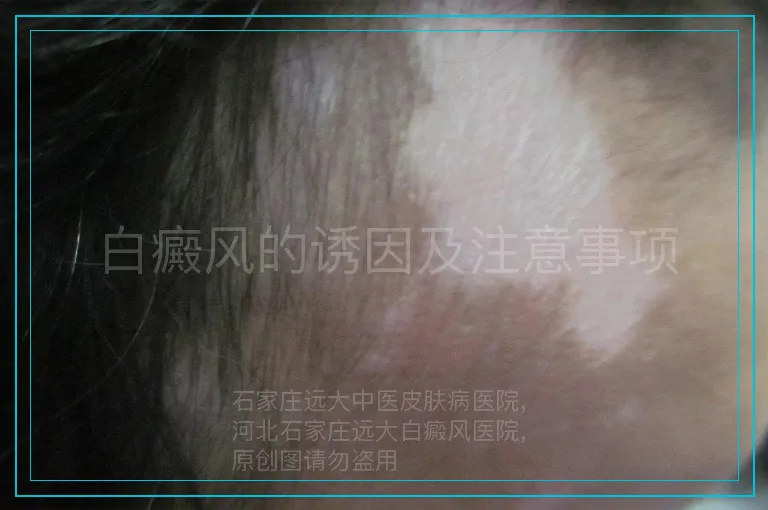 白癜风的诱因及注意事项