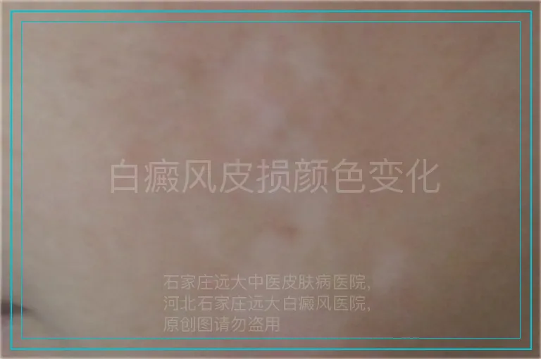 白癜风皮损颜色变化