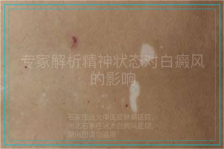 专家解析精神状态对白癜风的影响