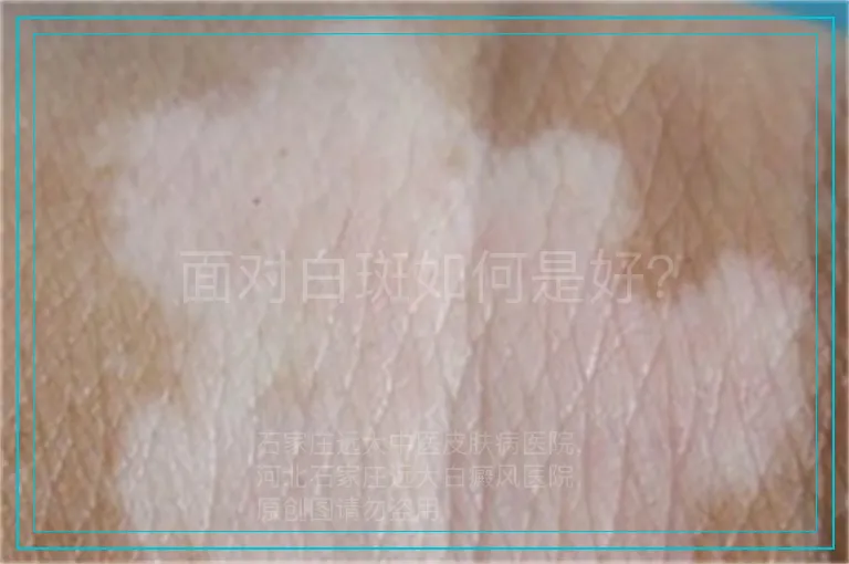面对白斑如何是好？