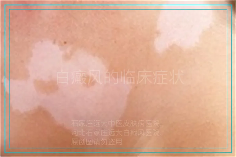 白癜风的临床症状