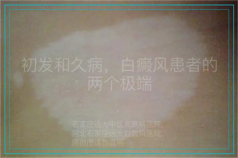 初发和久病，白癜风患者的两个极端