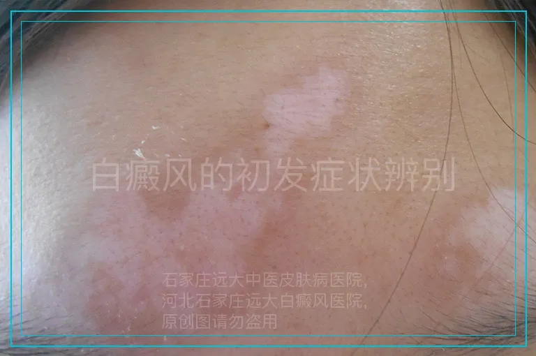 白癜风的初发症状辨别