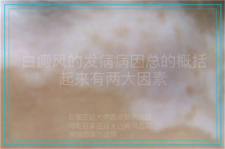 白癜风的发病病因总的概括起来有两大因素