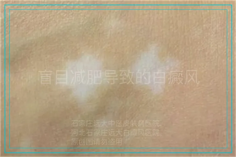 盲目减肥导致的白癜风