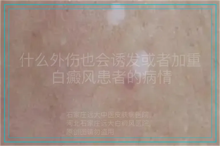 什么外伤也会诱发或者加重白癜风患者的病情