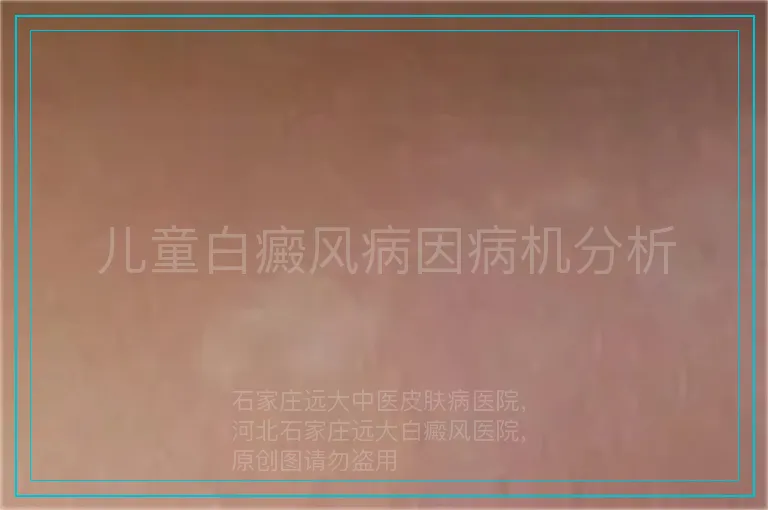 儿童白癜风病因病机分析