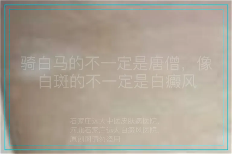 骑白马的不一定是唐僧，像白斑的不一定是白癜风