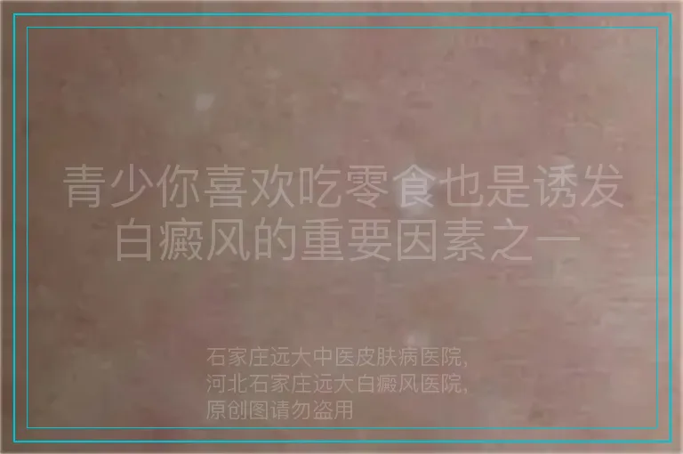 青少你喜欢吃零食也是诱发白癜风的重要因素之一