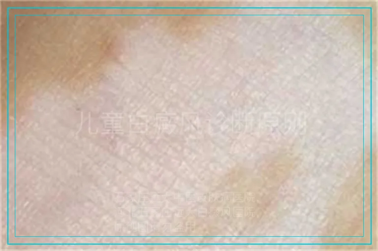 儿童白癜风诊断原则