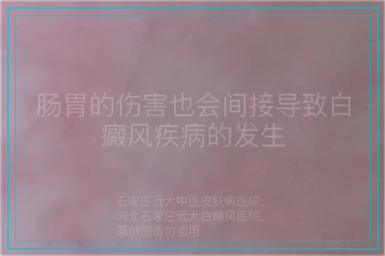 肠胃的伤害也会间接导致白癜风疾病的发生