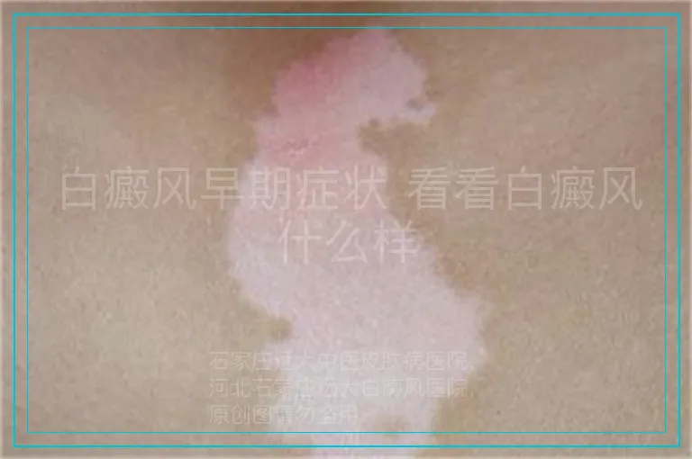 白癜风早期症状 看看白癜风什么样