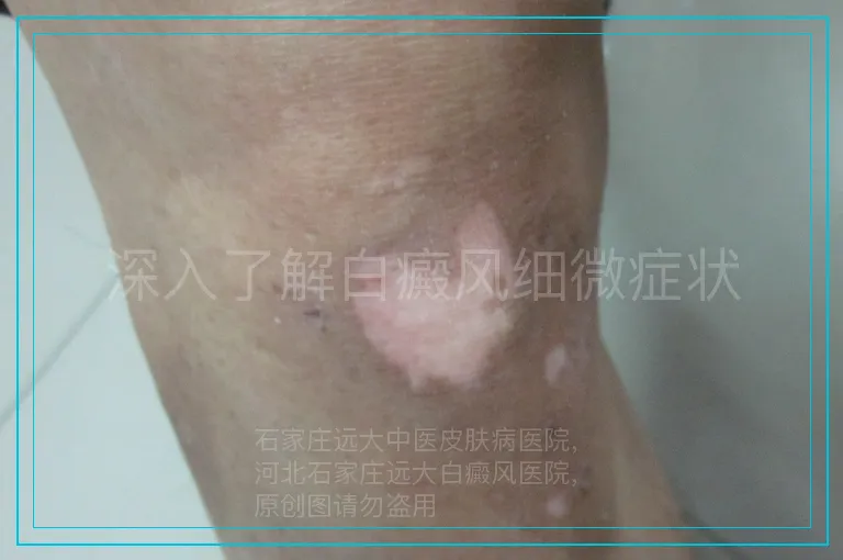 深入了解白癜风细微症状