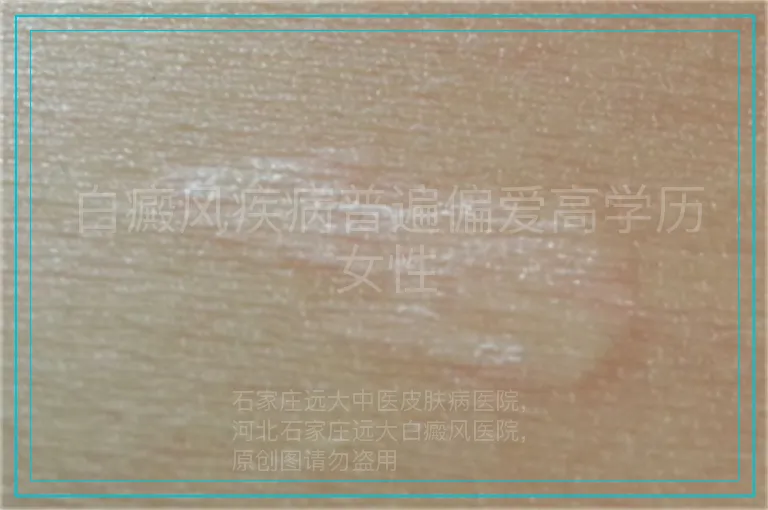 白癜风疾病普遍偏爱高学历女性
