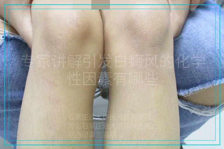 专家讲解引发白癜风的化学性因素有哪些
