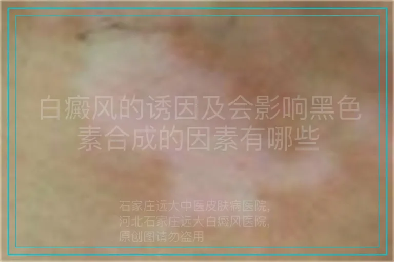 白癜风的诱因及会影响黑色素合成的因素有哪些