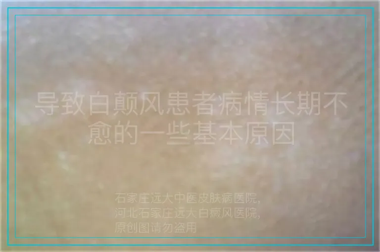 导致白颠风患者病情长期不愈的一些基本原因