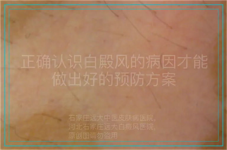 正确认识白殿风的病因才能做出好的预防方案