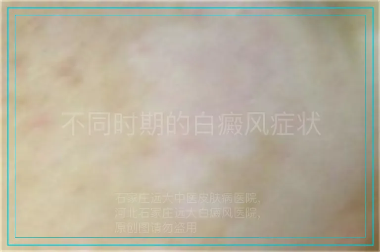 不同时期的白癜风症状