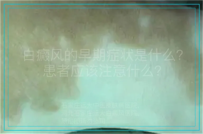 白癜风的早期症状是什么？患者应该注意什么？