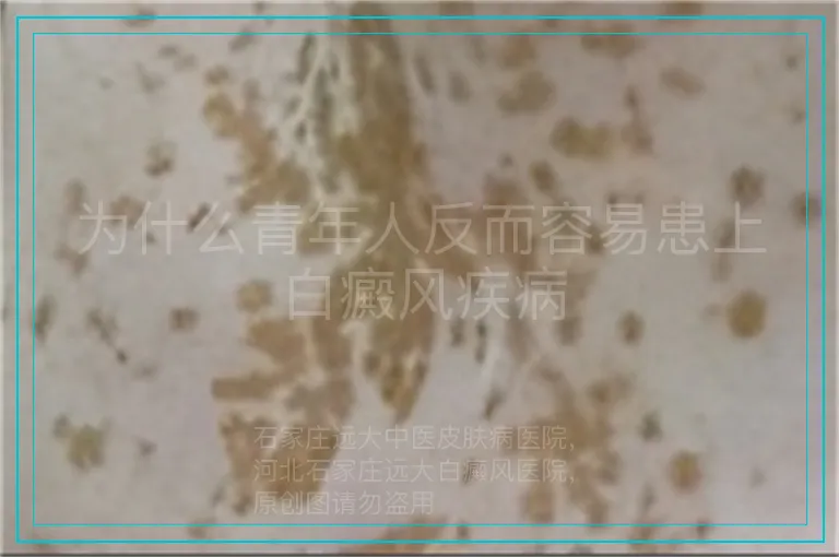为什么青年人反而容易患上白癜风疾病