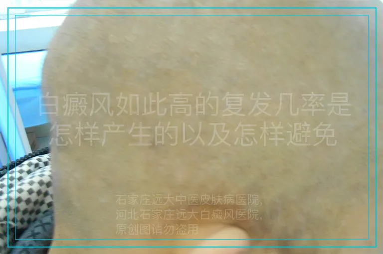 白癜风如此高的复发几率是怎样产生的以及怎样避免