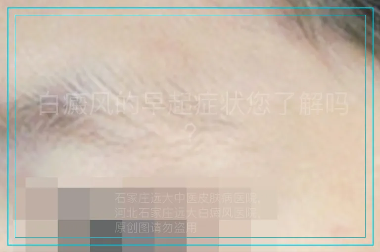 白癜风的早起症状您了解吗？