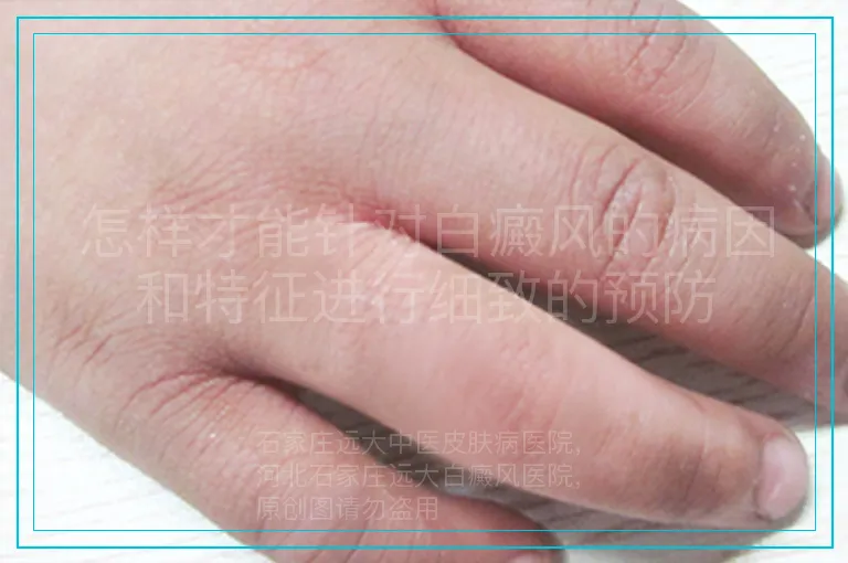 怎样才能针对白癜风的病因和特征进行细致的预防
