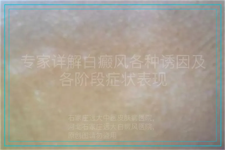 专家详解白癜风各种诱因及各阶段症状表现