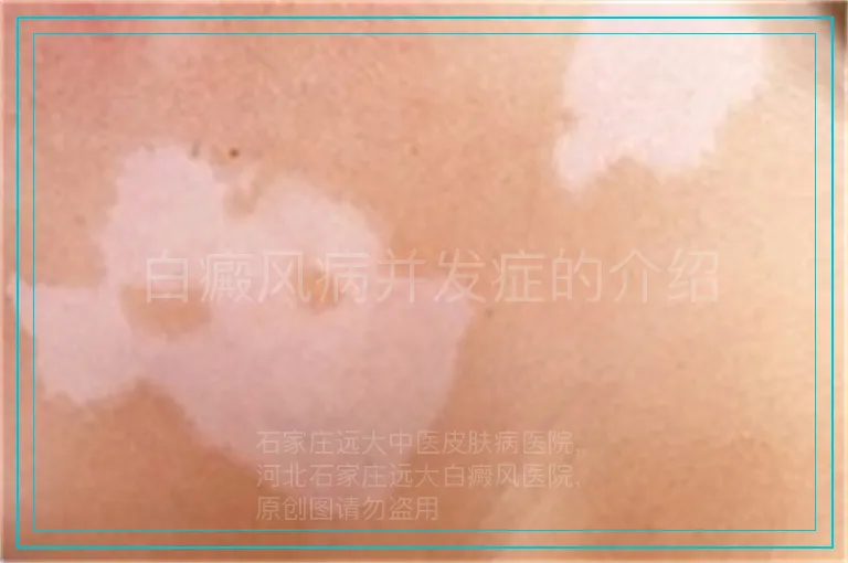 白癜风病并发症的介绍
