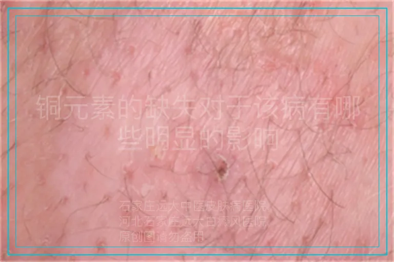 铜元素的缺失对于该病有哪些明显的影响