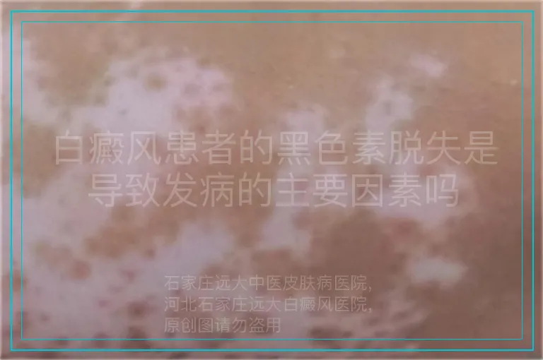 白癜风患者的黑色素脱失是导致发病的主要因素吗