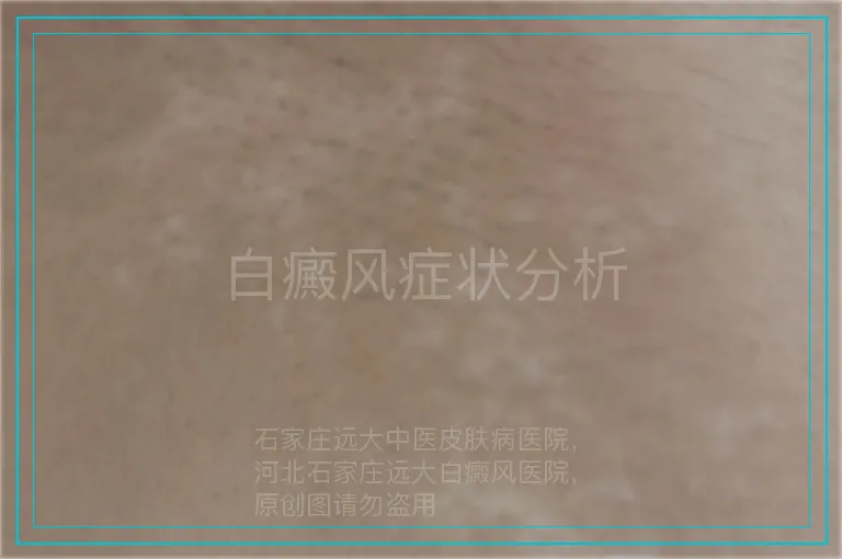 白癜风症状分析