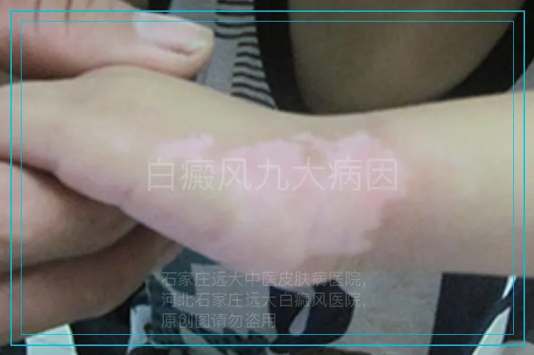 白癜风九大病因