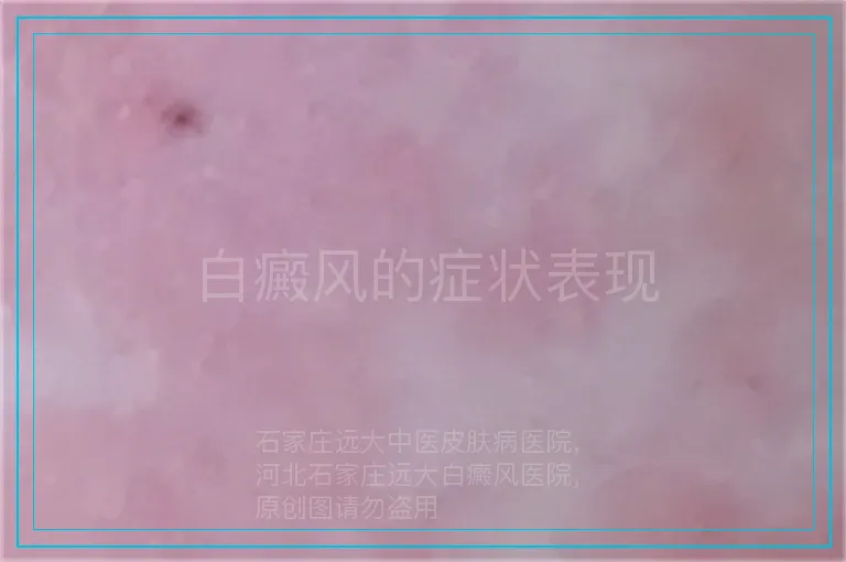白癜风的症状表现