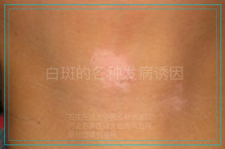 白斑的各种发病诱因