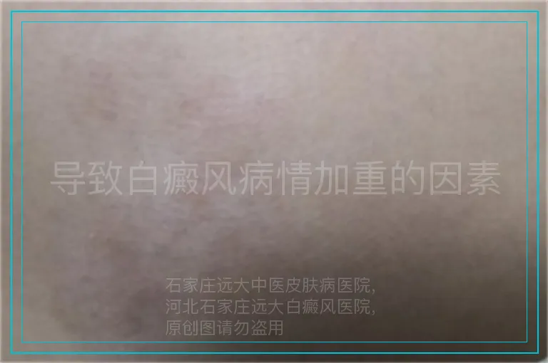 导致白癜风病情加重的因素