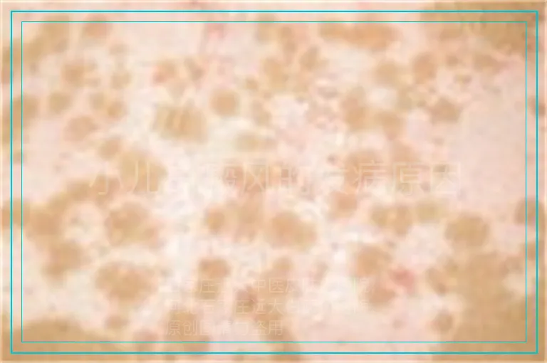 小儿白癜风的发病原因