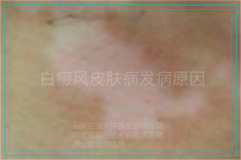 白癜风皮肤病发病原因