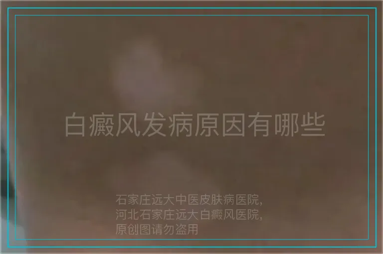 白癜风发病原因有哪些