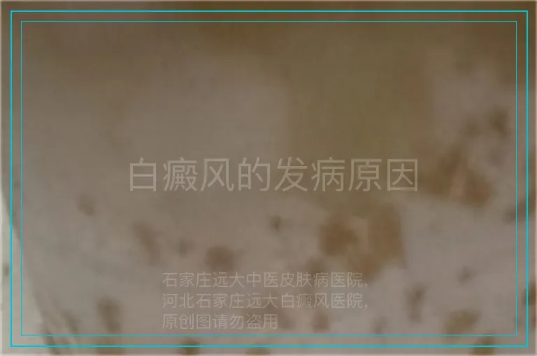 白癜风的发病原因