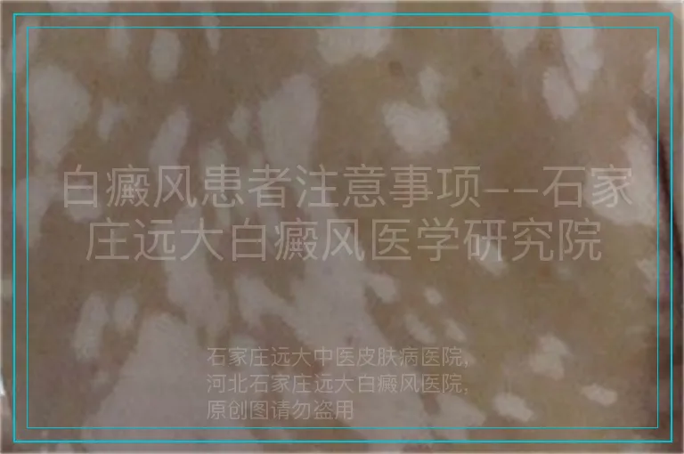 白癜风患者注意事项--石家庄远大白癜风医学研究院