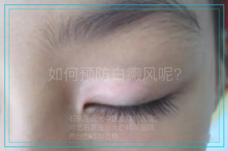 如何预防白癜风呢?