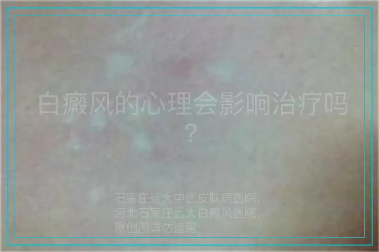白癜风的心理会影响治疗吗?